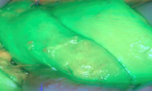 Photo of green dye used during ovarian cancer surgery