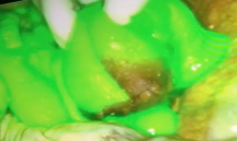 Photo of green dye used during ovarian cancer surgery